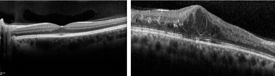 Desprendimiento de Retina