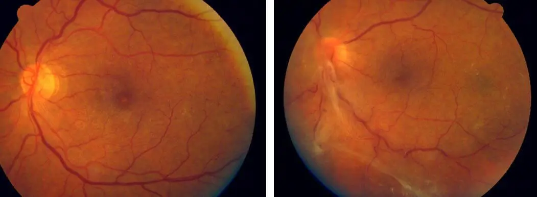 Desprendimiento de Retina