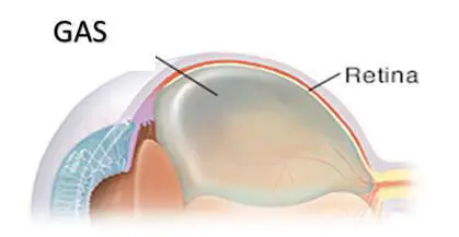 retinopexia neumática